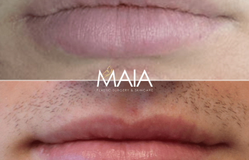 male before and after lip reduction