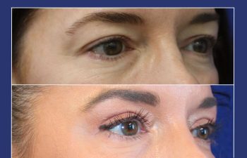 43 year old before and after an upper eyelid lift (upper blepharoplasty)