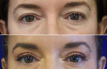 43 year old before and after an upper eyelid lift (upper blepharoplasty)