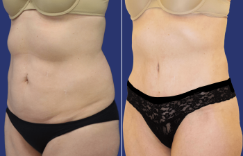 52 year-old mother of 2 before and 7 weeks after tummy tuck and flank liposuction