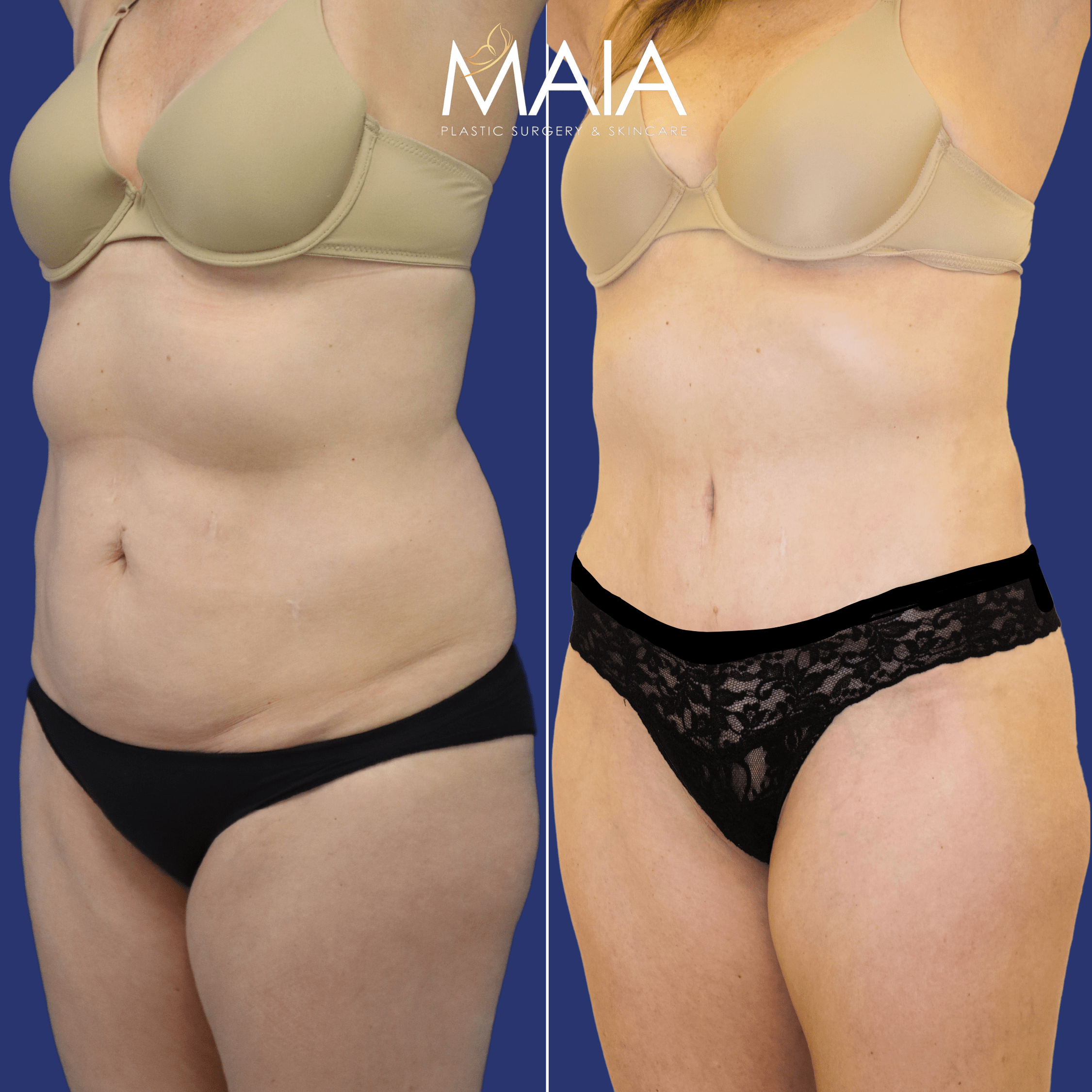 🥇 Liposuction  Maia Plastic Surgery