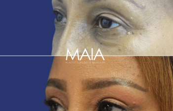 54 year old patient before and after upper blepharoplasty