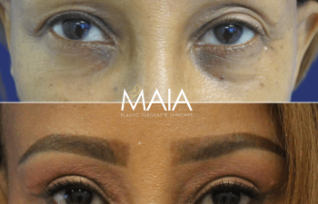 54 year old patient before and after upper blepharoplasty
