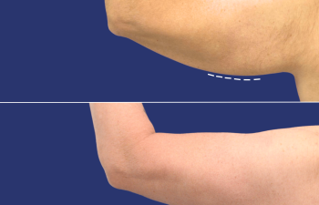 59 year-old male before and 14 months after arm lift