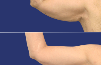 59 year-old male before and 14 months after arm lift
