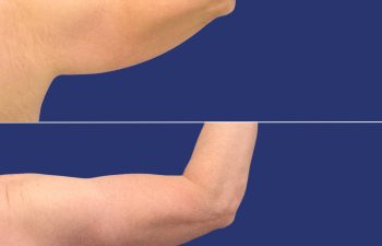 59 year-old male before and 14 months after arm lift