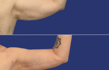 59 year-old male before and 14 months after arm lift