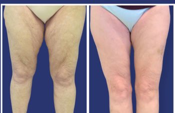 60 year-old before and after thigh lift