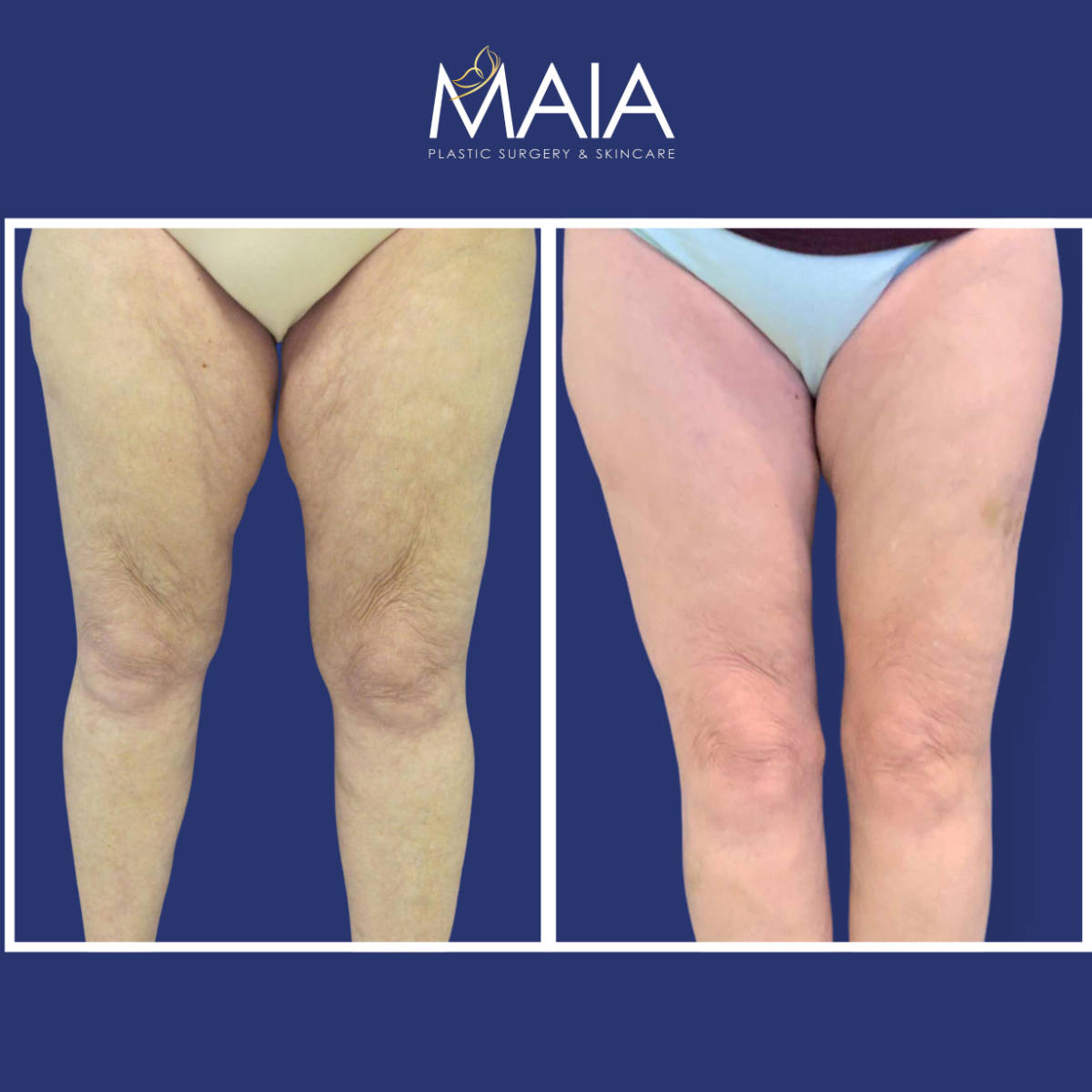 60 year-old before and after thigh lift
