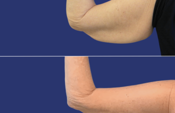 60 year-old female before and after an arm lift