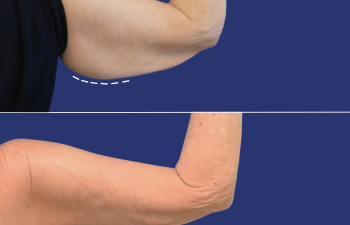 60 year-old female before and after an arm lift