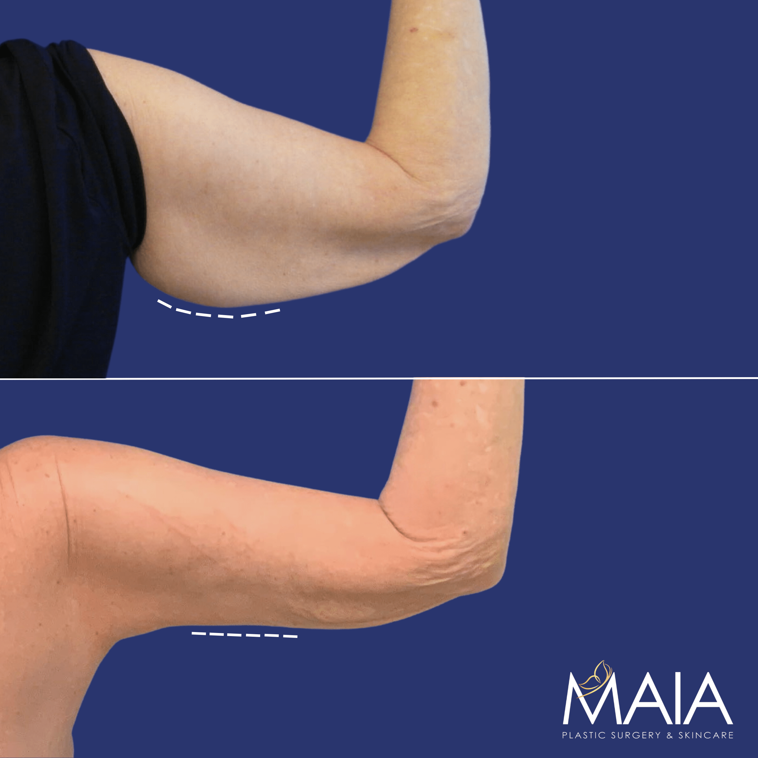 60 year-old female before and after an arm lift
