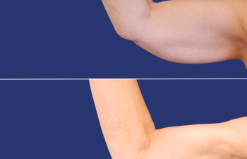 64 year-old female before and 10 months after arm lift