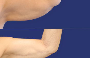 64 year-old female before and 10 months after arm lift