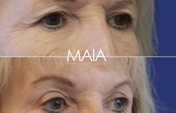 82 year-old patient before and after upper and lower blepharoplasty