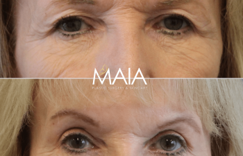 82 year-old patient before and after upper and lower blepharoplasty