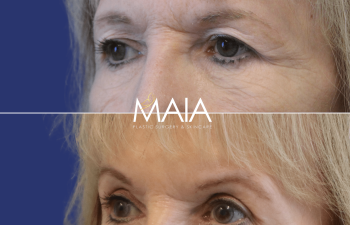 82 year-old patient before and after upper and lower blepharoplasty