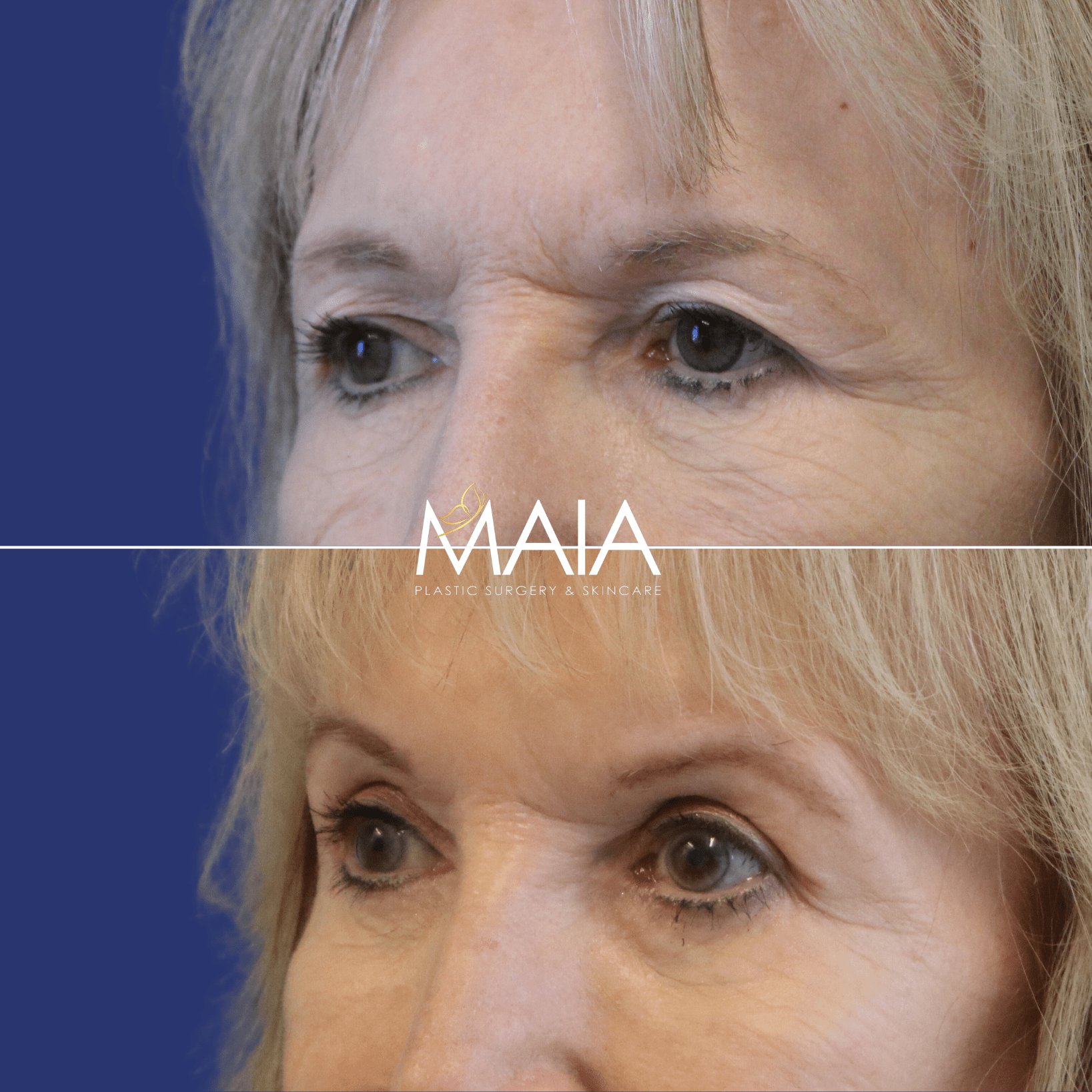 82 year-old patient before and after upper and lower blepharoplasty