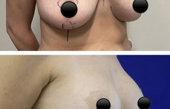 Breast Augmentation with Lift