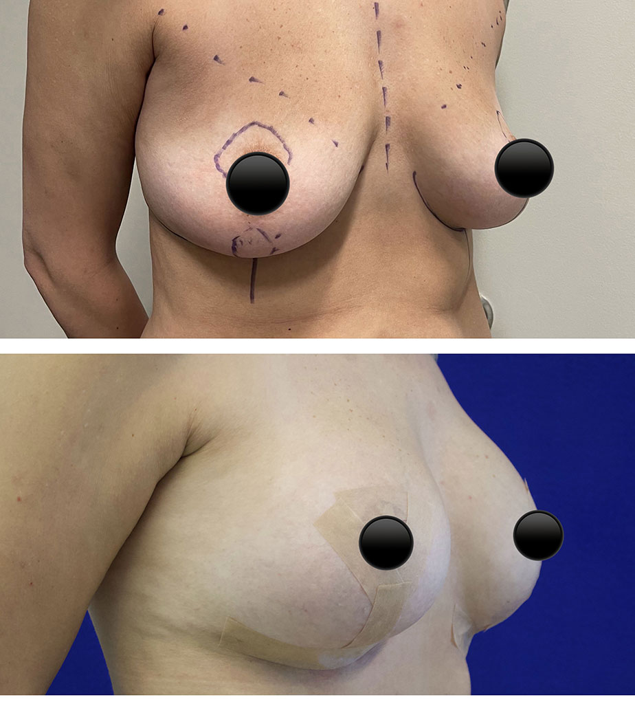 Breast Augmentation with Lift