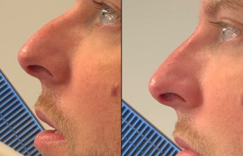 Male patient before and after non-surgical rhinoplasty