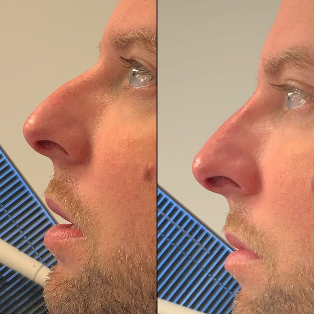 Male patient before and after non-surgical rhinoplasty