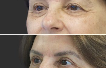 69 year-old patient before and after an Upper Eyelid Lift (Upper Blepharoplasty)