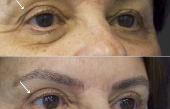 69 year-old patient before and after an Upper Eyelid Lift (Upper Blepharoplasty)