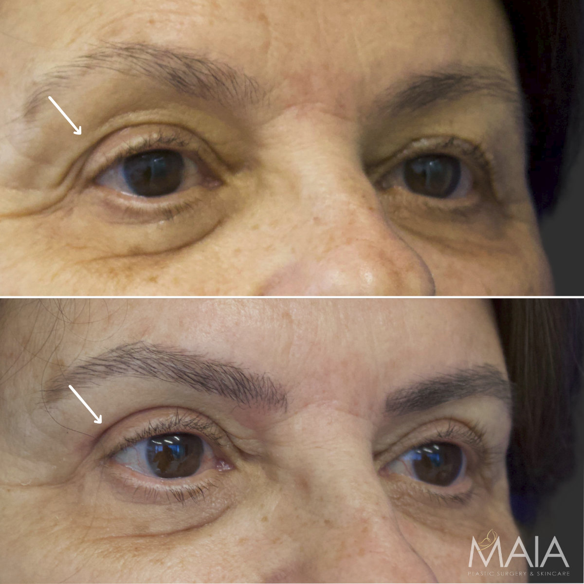69 year-old patient before and after an Upper Eyelid Lift (Upper Blepharoplasty)