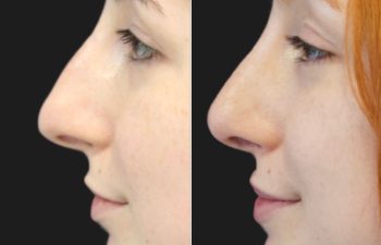 25 year-old female before and 1 year after rhinoplasty and septoplasty