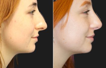 25 year-old female before and 1 year after rhinoplasty and septoplasty