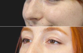 25 year-old female before and 1 year after rhinoplasty and septoplasty
