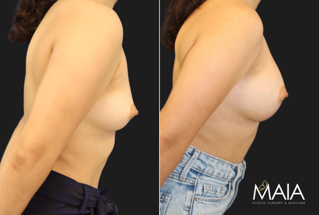 27 year-old patient before and 6 months after breast augmentation with gummy bear implants