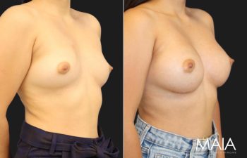 27 year-old patient before and 6 months after breast augmentation with gummy bear implants