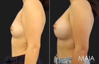 27 year-old patient before and 6 months after breast augmentation with gummy bear implants