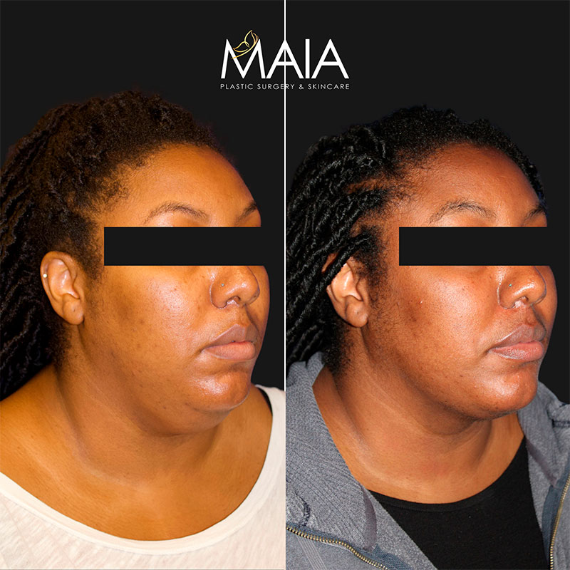 🥇 Liposuction  Maia Plastic Surgery