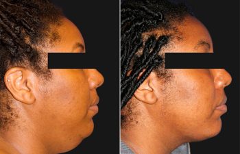 29 year-old patient with Paradoxical Adipose Hyperplasia (PAH) before and 5 weeks after neck liposuction.