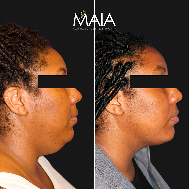 🥇 Liposuction  Maia Plastic Surgery