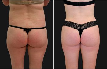 before and after liposuction procedure