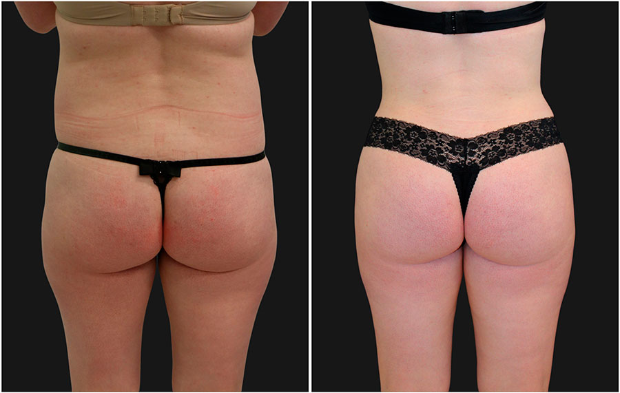 Liposuction of Flanks Before and After 3804