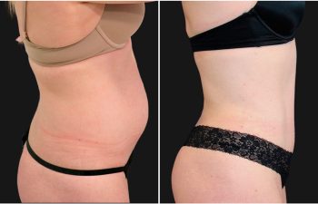 before and after tummy tuck procedure