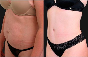 before and after tummy tuck procedure
