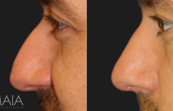 36 year-old male before and 1 month after rhinoplasty