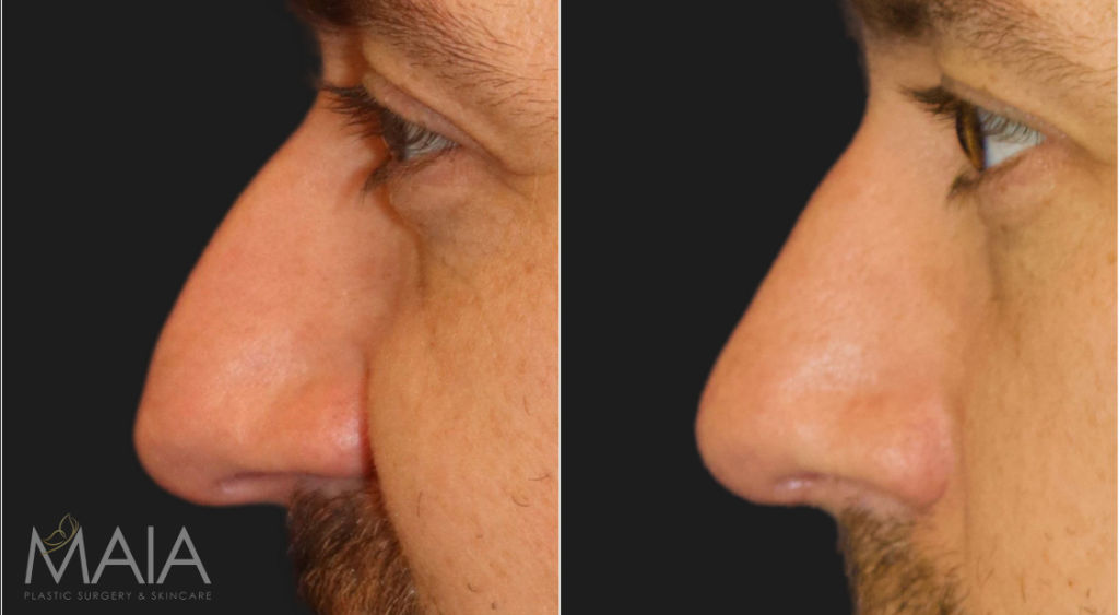 36 year-old male before and 1 month after rhinoplasty