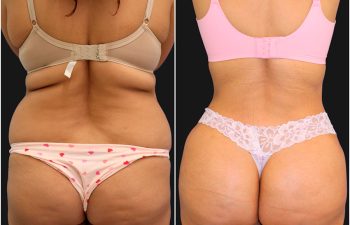 before and after liposuction procedure