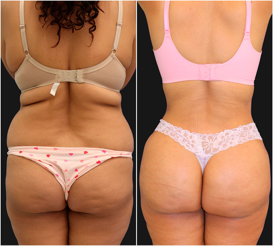 Will Lower Back Liposuction Also Address The Flanks?