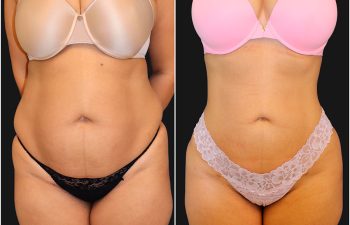 before and after liposuction procedure