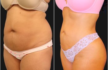 before and after liposuction procedure