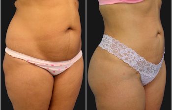 before and after liposuction procedure