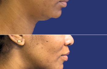 41 year-old before and 3 weeks after neck liposuction